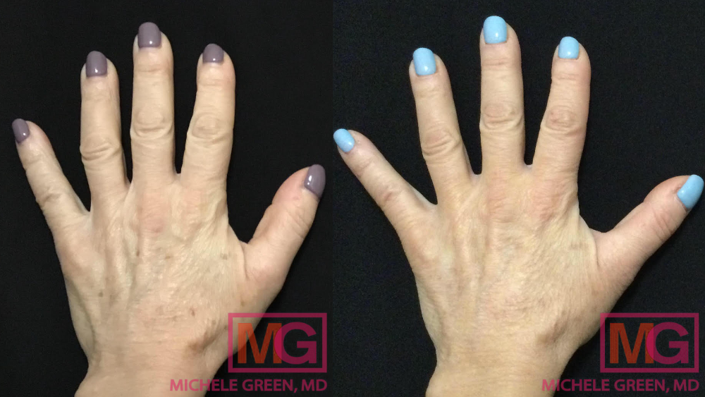 BM 61 yo female 2 and a half weeks before after age spot treatment Alex Trivantage laser MGWatermark