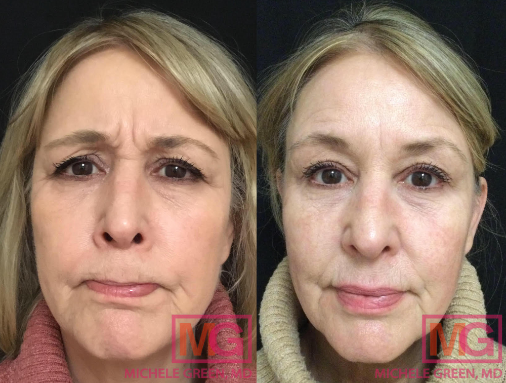 1 treatment of Botox - 9 days after