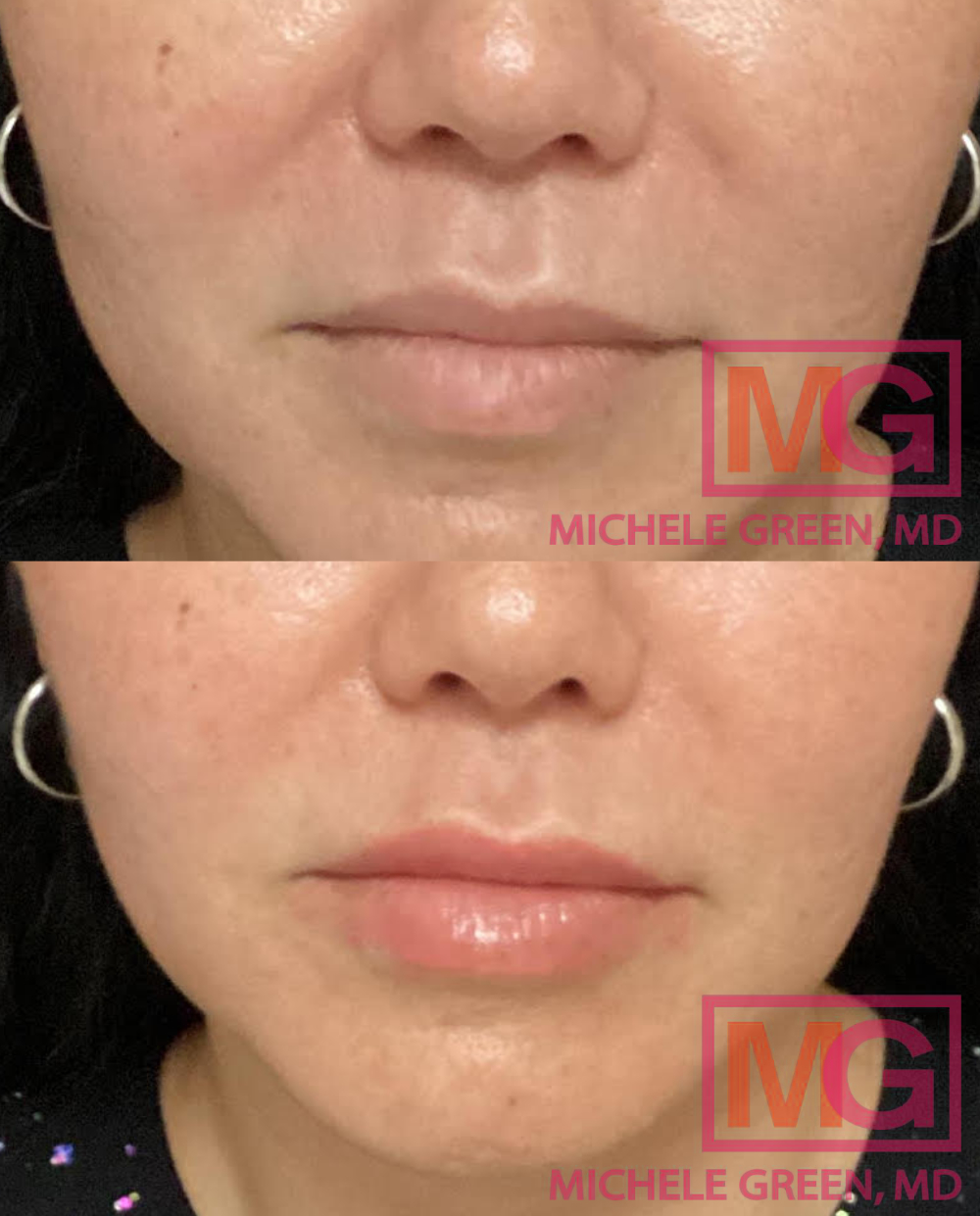 BM Before after 1 ultra in the lips LIPS ONLY MGWatermark