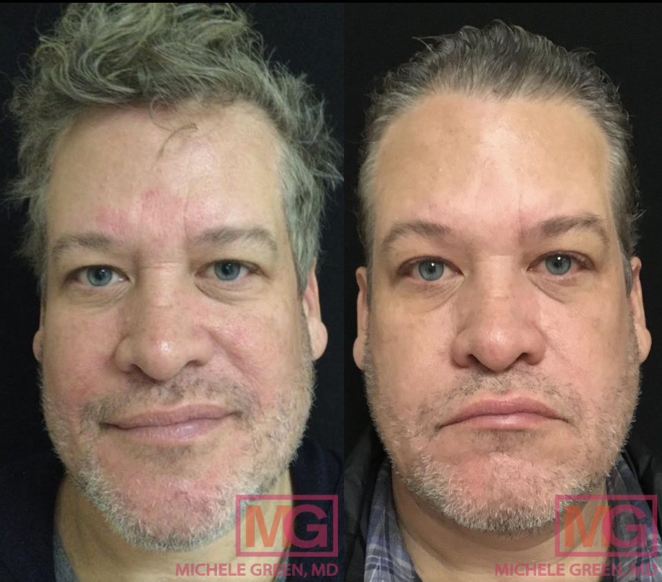 BR 50 yo male before after VBEAM and Botox glabella 3 months FRONT MGWatermark