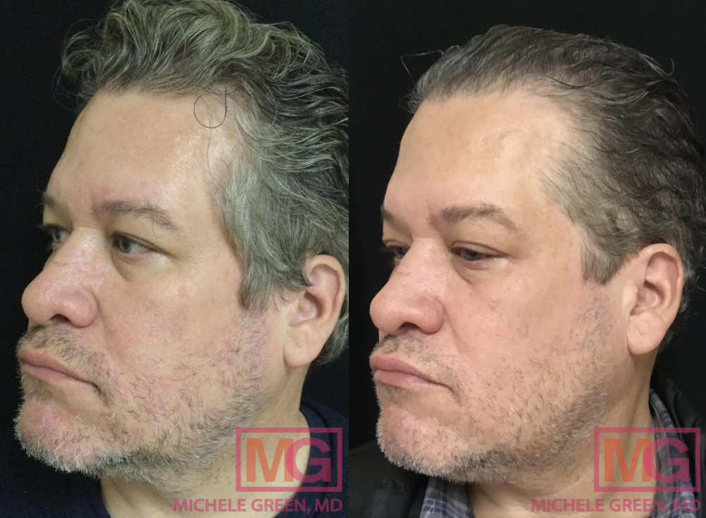 VBeam & Botox - 3 months before and after