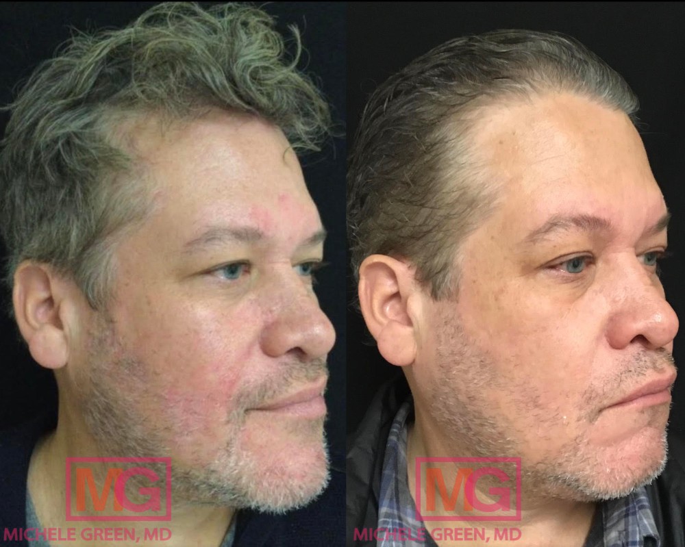 BR 50 yo male before after VBEAM and Botox glabella 3 months RIGHT MGWatermark 1