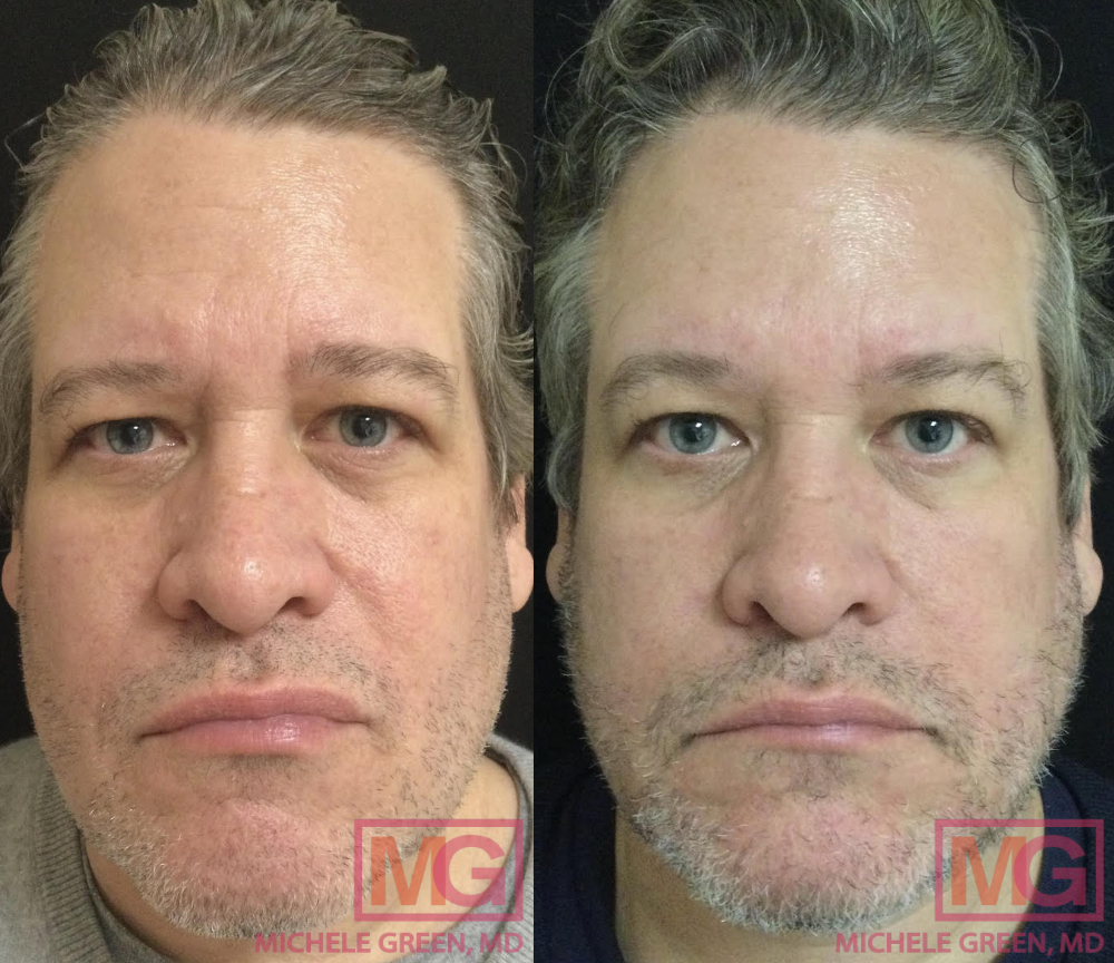 Botox & Vbeam, 3 treatments, 3 months
