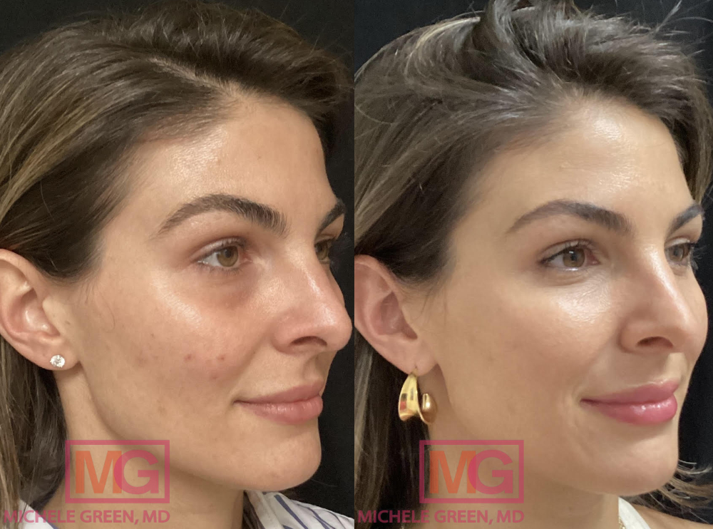 BS 30yo female before and after acne treatment RIGHT MGWatermark