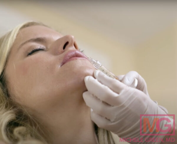 Juvederm Skinvive for Cheek Area, Skinvive by Juvederm - Dr. Michele ...