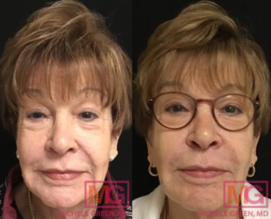 Sculptra vs. Radiesse, Choosing & Comparing Fillers - Dr. Michele Green