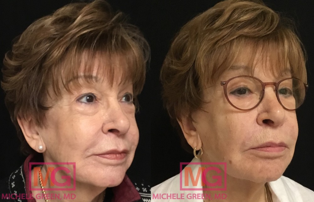 C.W 2 months Before and After Sculptra 2 vials2 MGWatermark