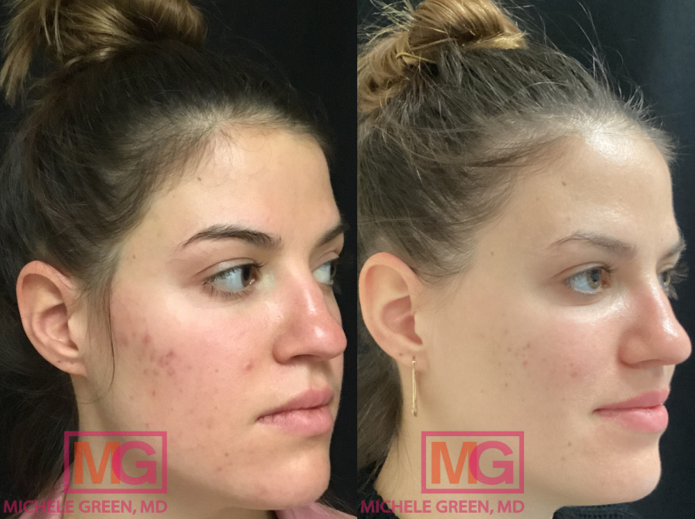 CC 26 year old before after Accutane MGWatermark