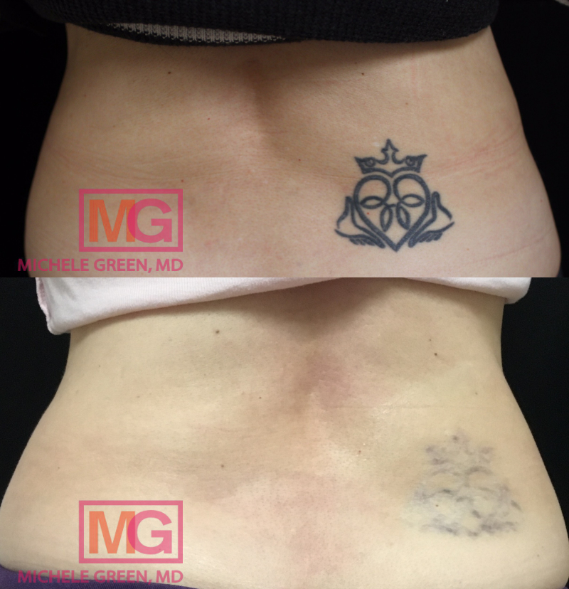 CF Before and After Tattoo Removal 8 sessions MGWatermark