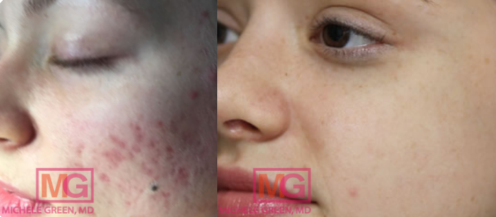 25-34 year old woman treated with acne scar treatment