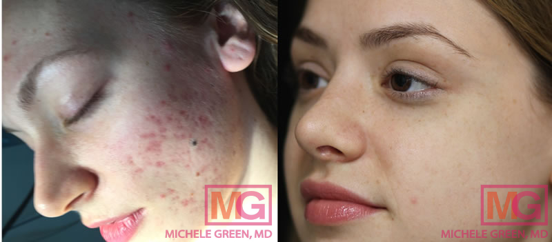 CG 24 female acne ematrix before after angle MGwatermark
