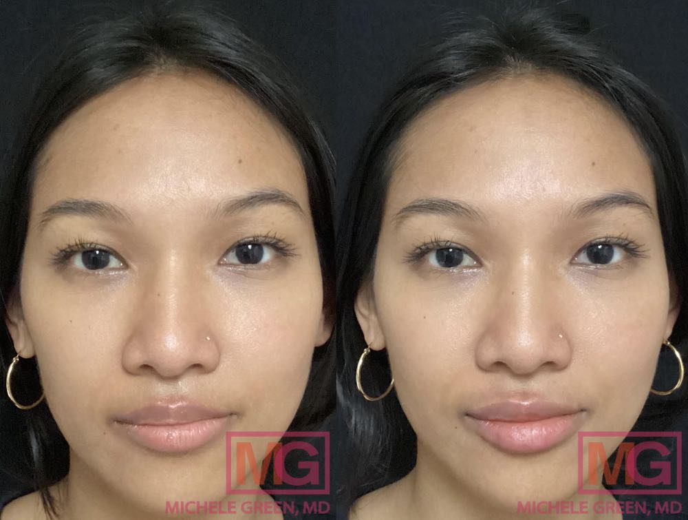 27 year old, Juvederm Ultra Plus in lips