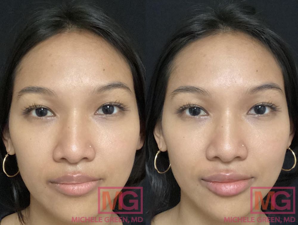 CK 27 yo femalebefore after Juvederm Ultra Plus in lips MGWatermark