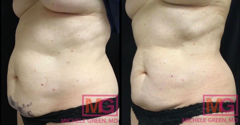 Coolsculpting abdomen, 6 months before and after