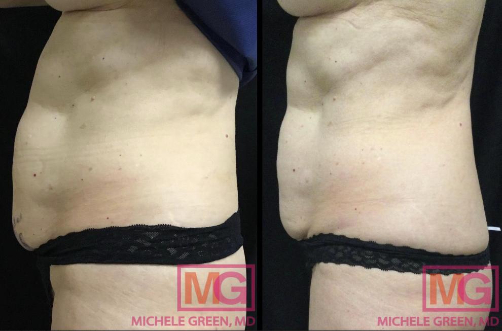 CM coolsculpting 63 left