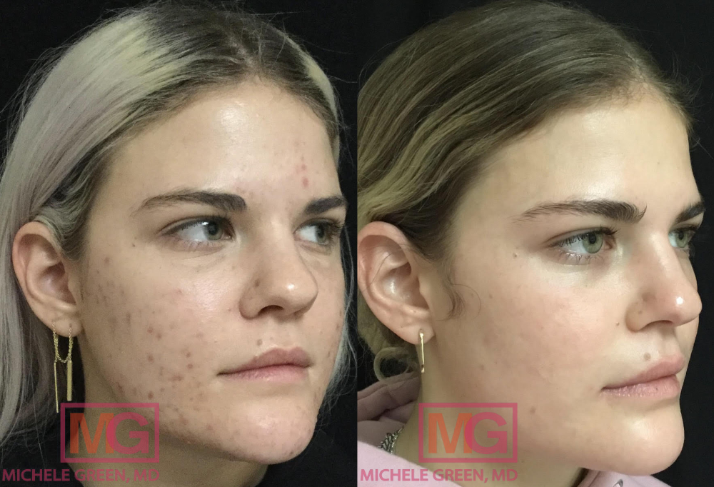 CP 22 y female before after Accutane 15mo ANGLER MGWatermark
