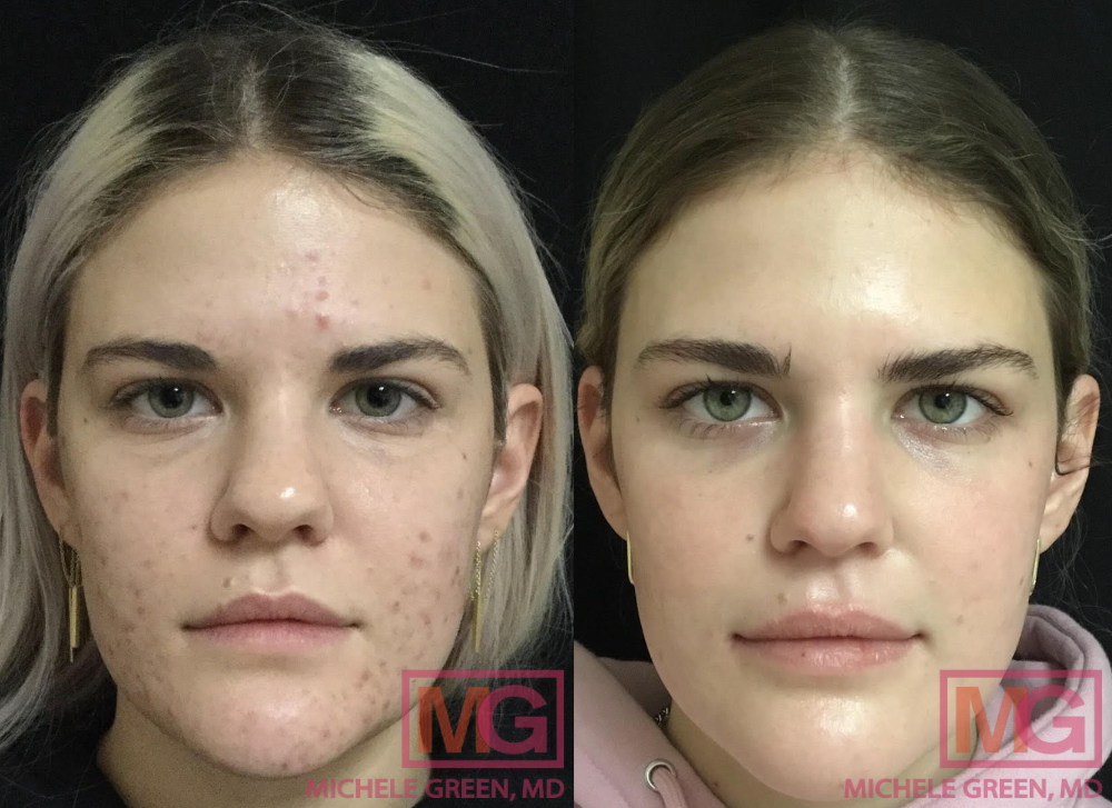 CP 22 y female before after Accutane 15mo FRONT MGWatermark