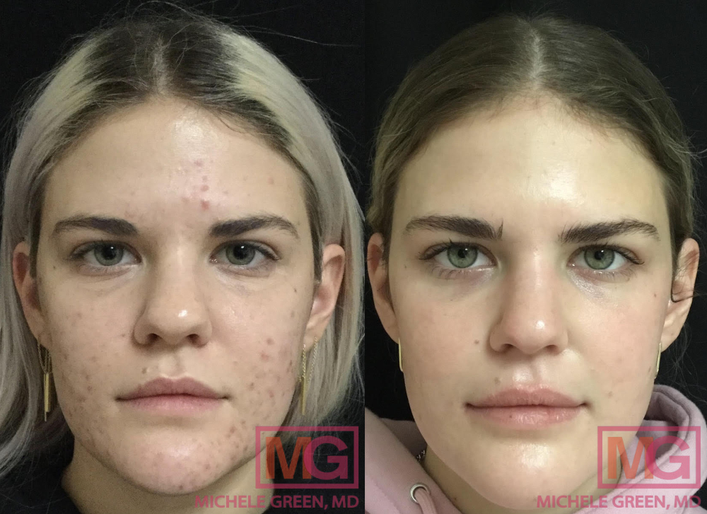 22 year old female, Accutane 5 months