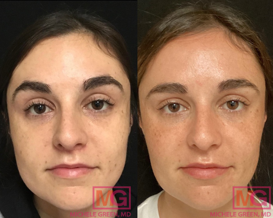 CS 29 yo female before and after Botox Masseter x4 1 year and 4