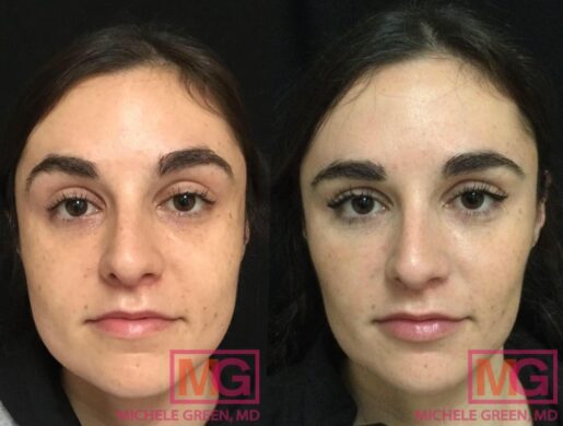 Does Tmj Surgery Change Your Face Botox TMJ (Temporomandibular Joint), TMD & Jaw Area