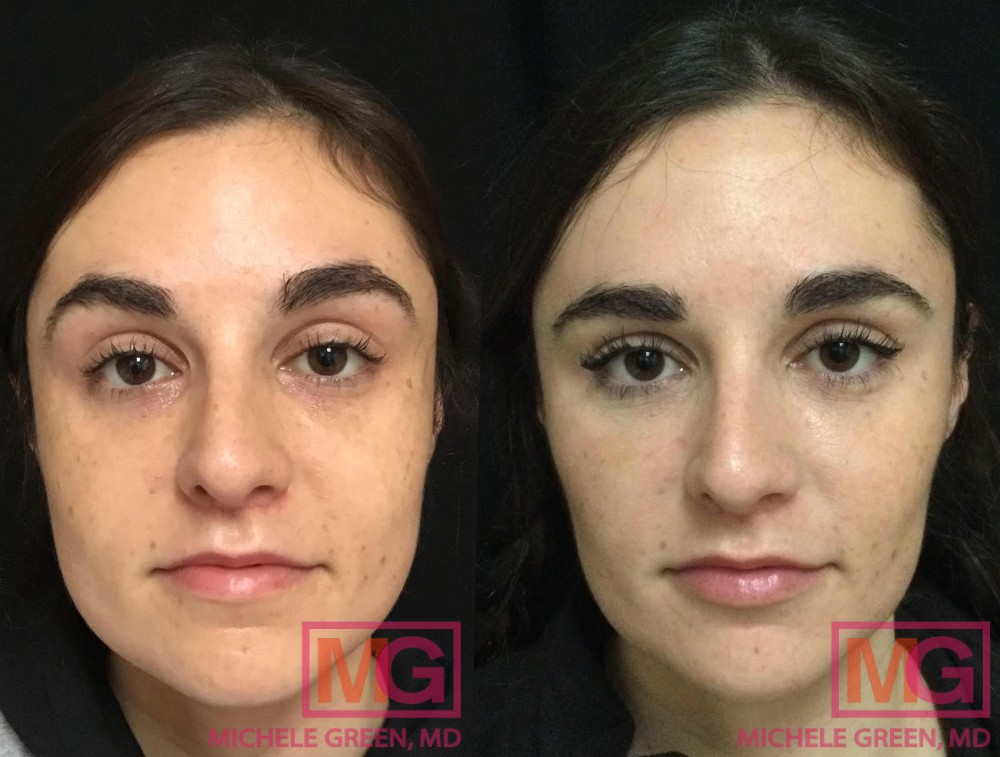 Female before and after 1 treatment Botox Masseter