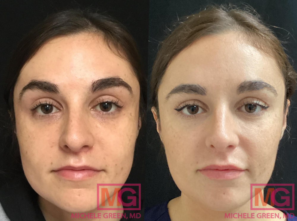 1 treatment of Botox in masseter area