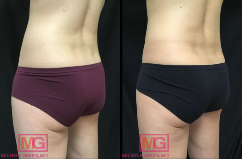CoolSculpting on love handles & inner thighs, 9 months post treatment