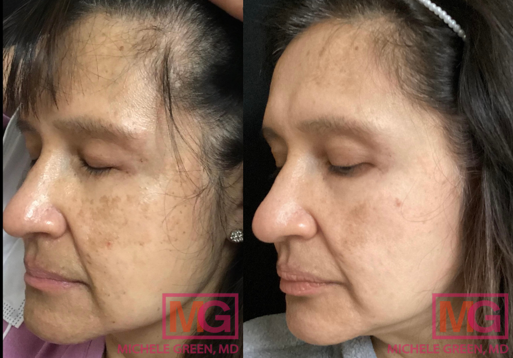 Before and after Cosmelan treatment - 6 months