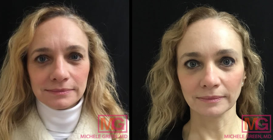 Juvederm Voluma 2 weeks