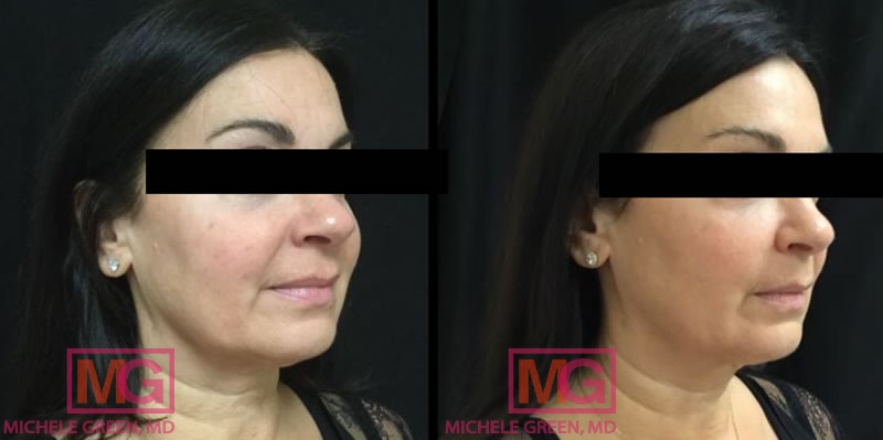 35-44 year old woman treated with Kybella, Fraxel, & Botox (forehead, glabella & crows feet)