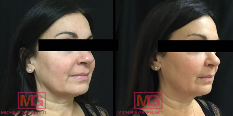 DG 43 Fraxel Botox Kybella 3m ANGLER 1 MGwatermark