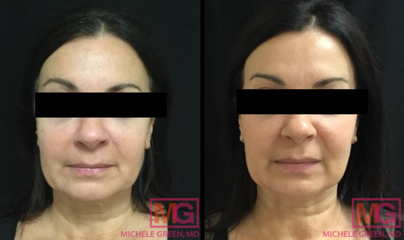 DG 43 Fraxel Botox Kybella 3m FRONT 3 MGwatermark