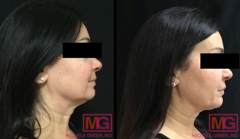 Kybella Double Chin Injections - Dr. Michele Green M.D. NYC