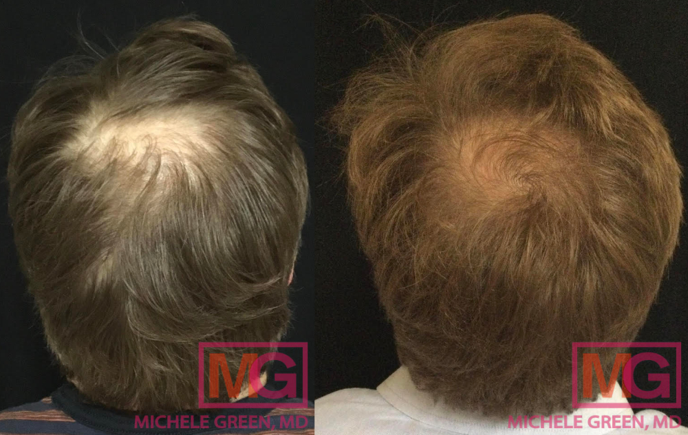 Male with PRP treatment on hair – 6 treatments