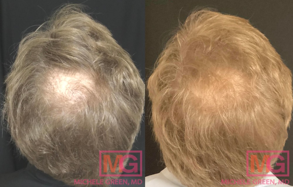 Microneedling Before & After Photos - Dr. Michele Green M.D.