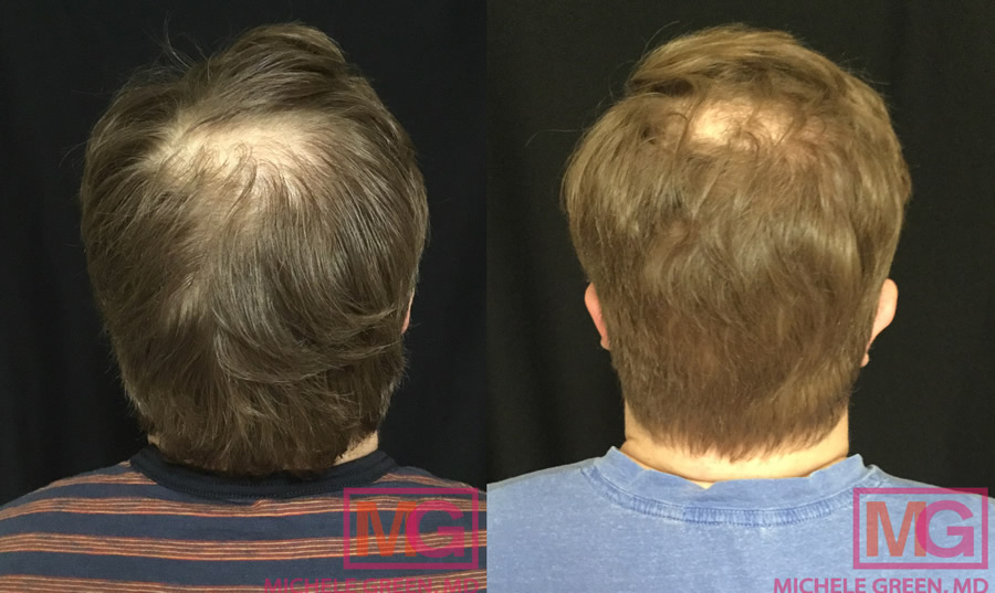 Male with PRP treatment on hair – 7 months