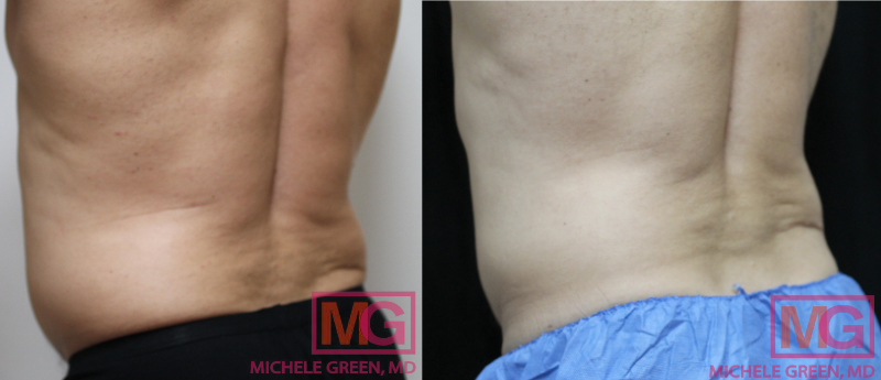 DM Before and After Coolsculpting CoolAdvantage CoolCurve RT Flank MGWatermark