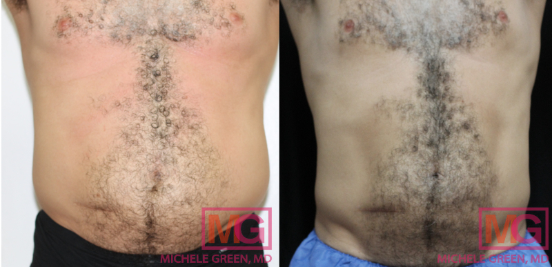 Male CoolSculpting treatment on body