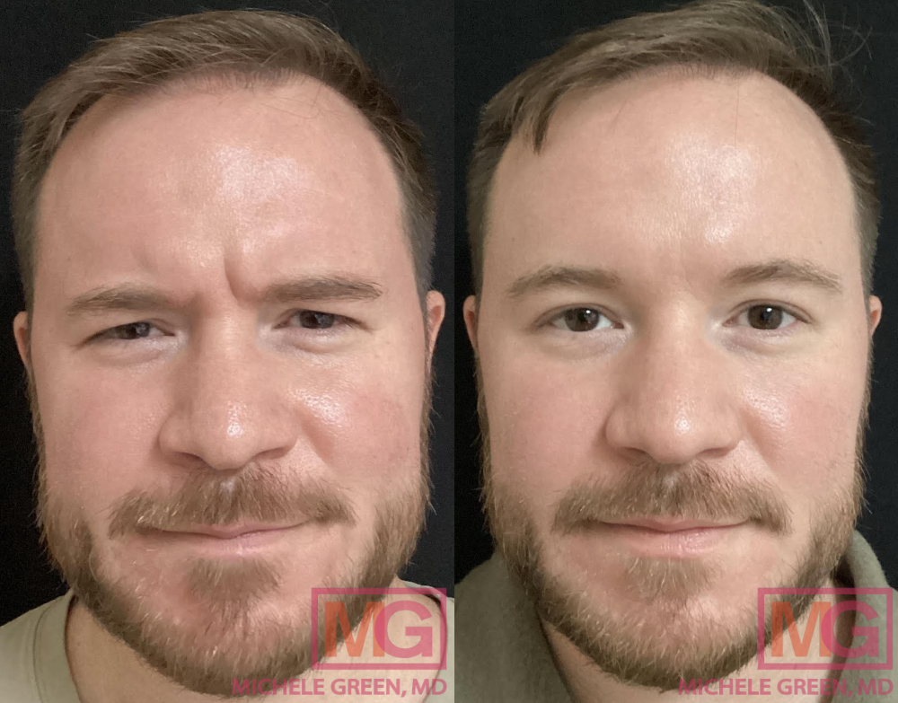 Male before and after, Botox in Glabella and Masseter area