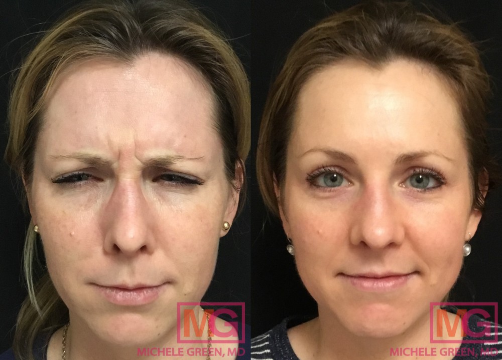 E.A 35 year old female 2 weeks Before and After Botox Forehead Glabella Crowsfeet MGWatermark