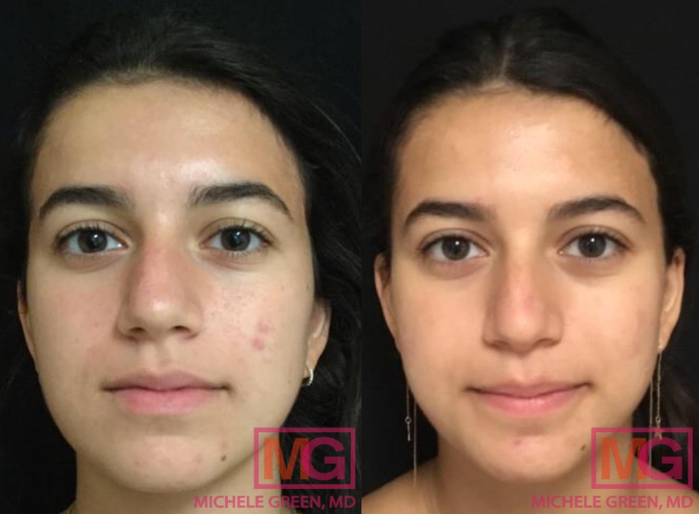 22 year old before and after acne surgery