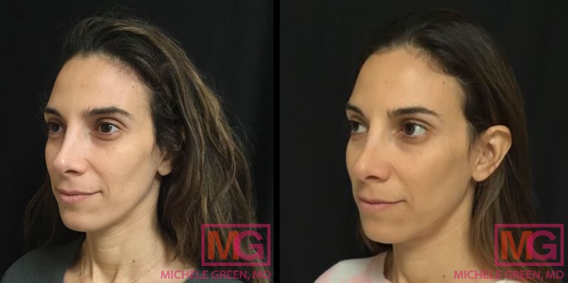 40 year old, Juvederm Voluma