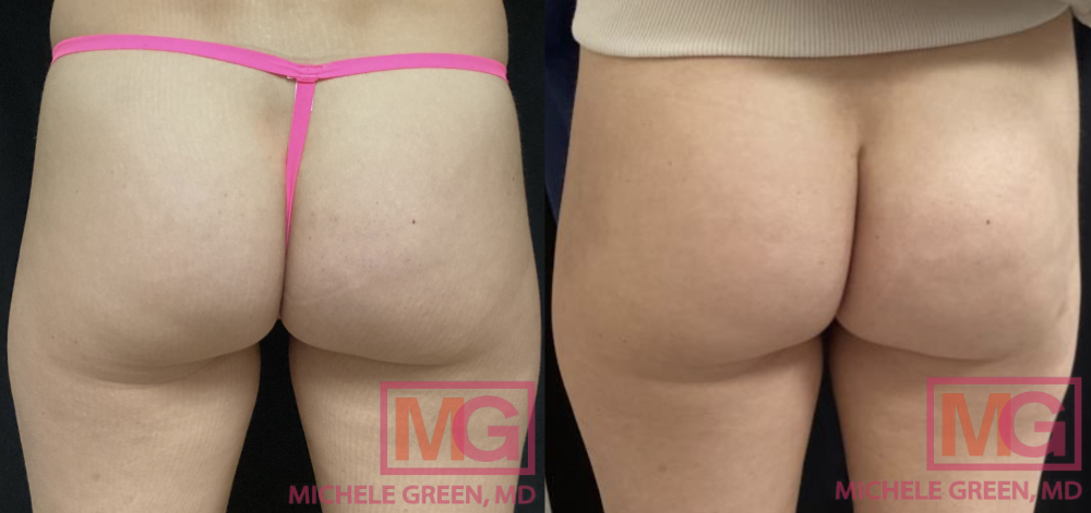 EF Before and after 2 sessions Sculptra 2 months BACK MGWatermark