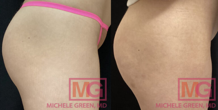 Sculptra Hip Dips Hip Dip Filler Dr Michele Green M D NYC sculptra-hip-dips-hip-dip-filler-dr-michele-green-m-d-nyc