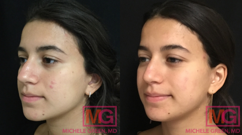 22 year old female, before and after acne treatment