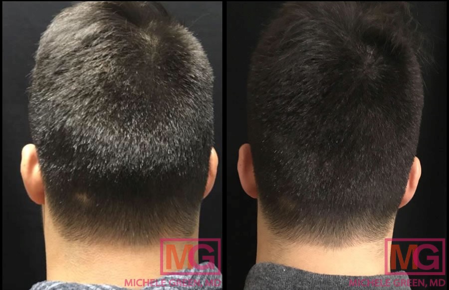 EH 32 alopecia 2m 900 BACK2 2