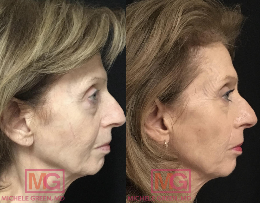 68 year old female before and after Thermage 6 months