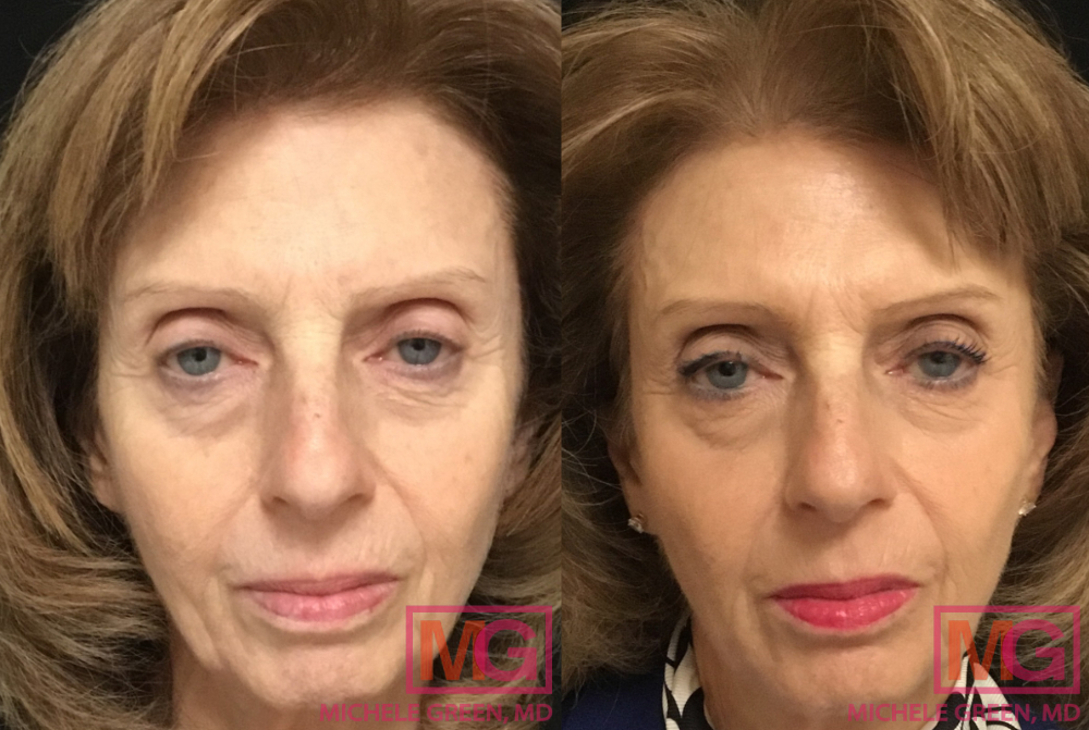 69 year old female Before and After Sculptra