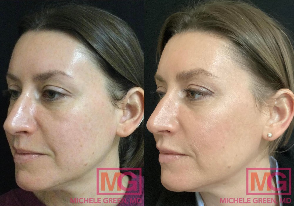 ER 45 yo female before after Juvederm Ultra Plus 1 syringe lips and nasolabial and Voluma 2 and a half syringes in cheeks 2 months apart LEFT MGWatermark 1