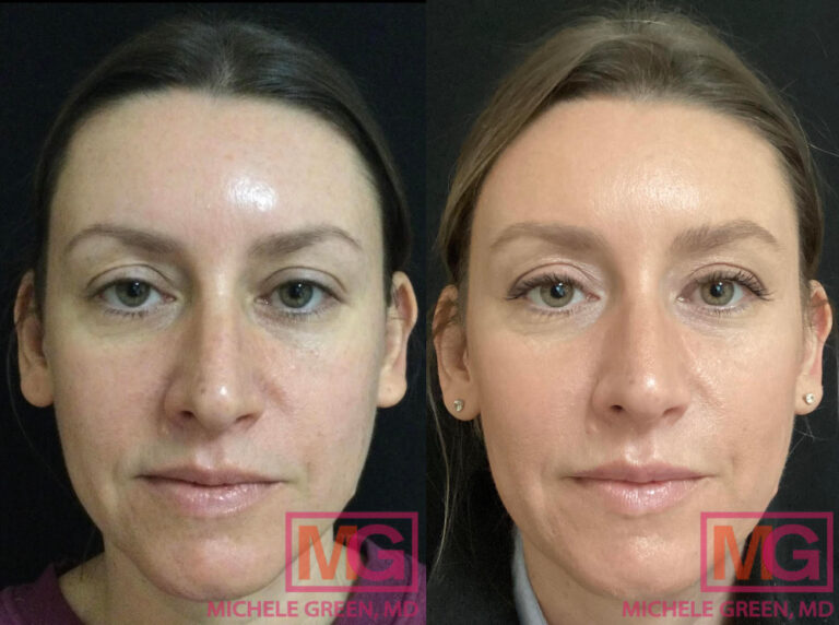 Juvederm NYC Juvederm Injections For Lines & Wrinkles